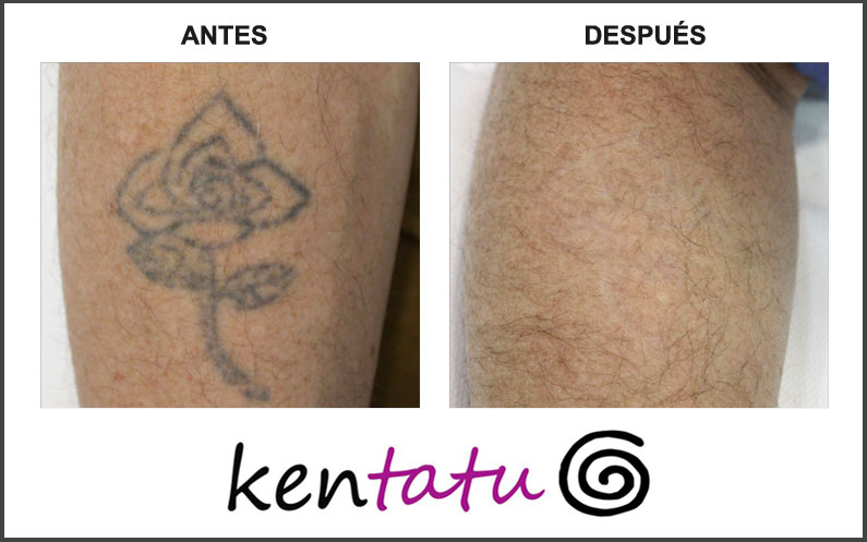 Eliminación de tatuaje del antebrazo