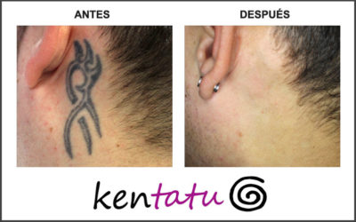 Eliminación de tatuaje detrás de la oreja