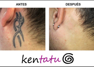 Tatuaje quitado con láser