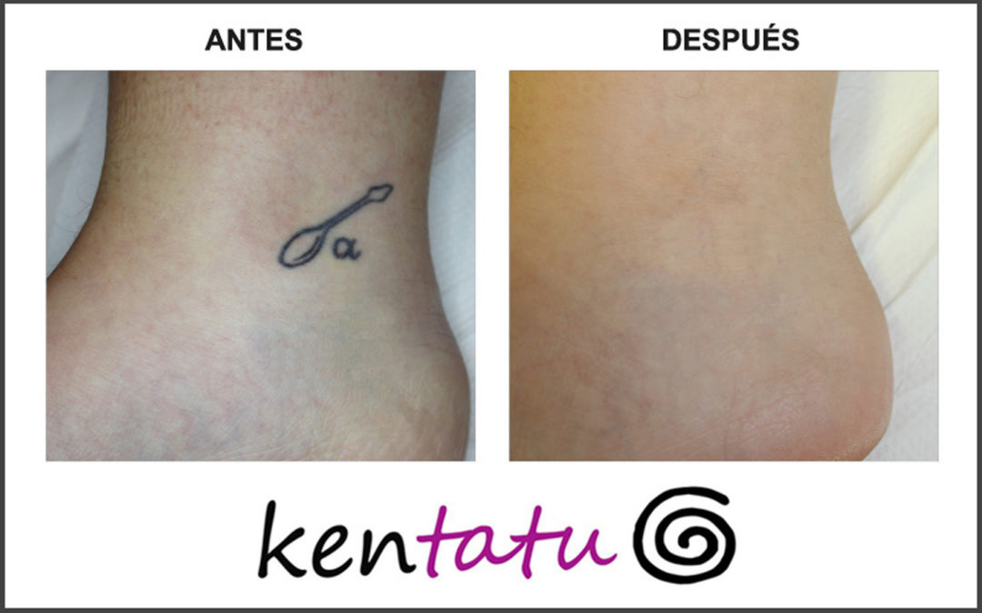 Eliminación de Tatuaje