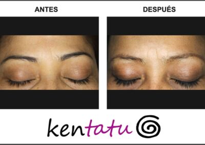 eliminacion-de-micropigmentacion-de-cejas