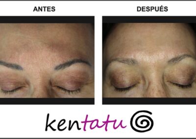 eliminacion-de-tatuaje-permantente-de-cejas