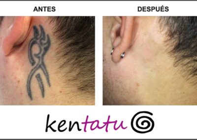 tatuaje-quitado-con-laser-detras-de-la-oreja